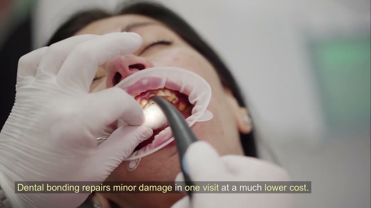 Veneers, Bonding, or Whitening - Which Cosmetic Dental Option Is Right for What You Actually Want to