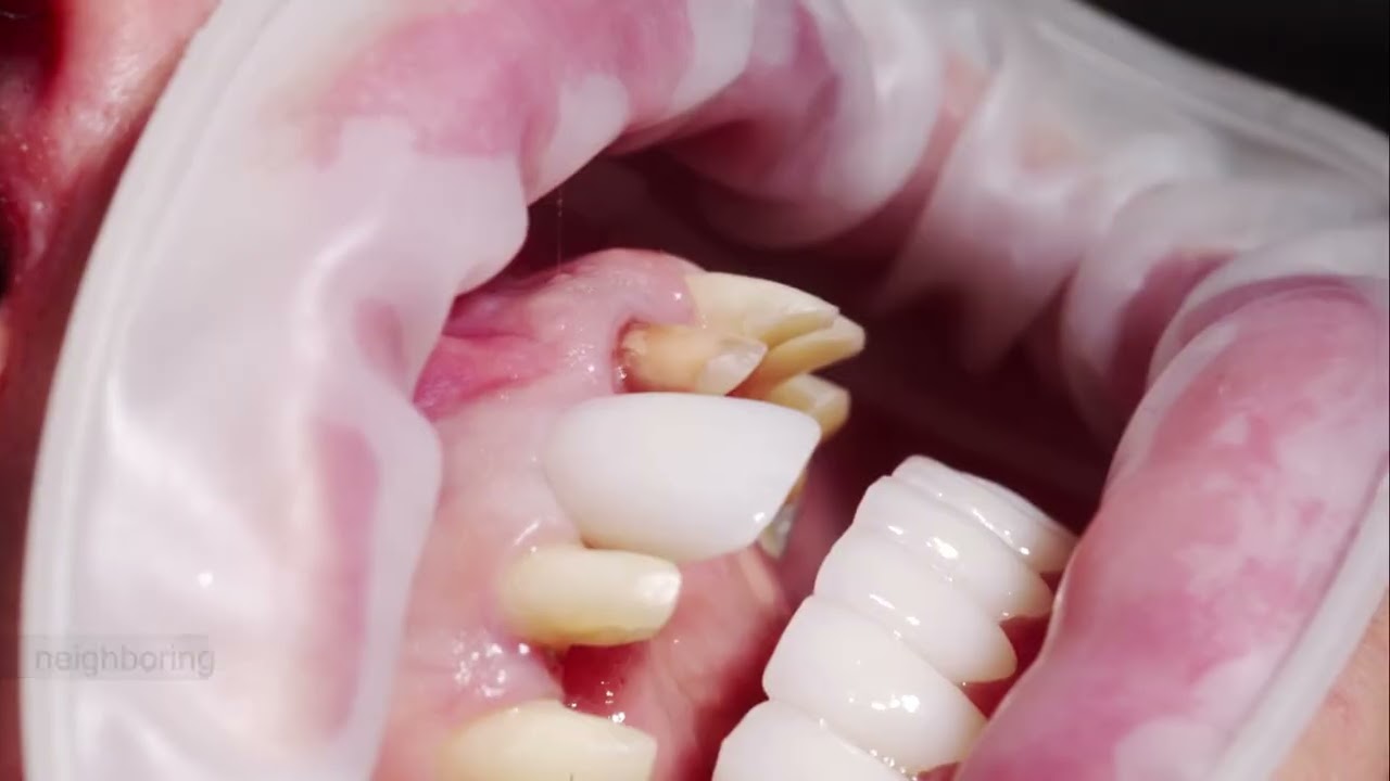 Dental Implants vs. Dentures vs. Bridges - The Honest Comparison Leesburg Patients Actually Need