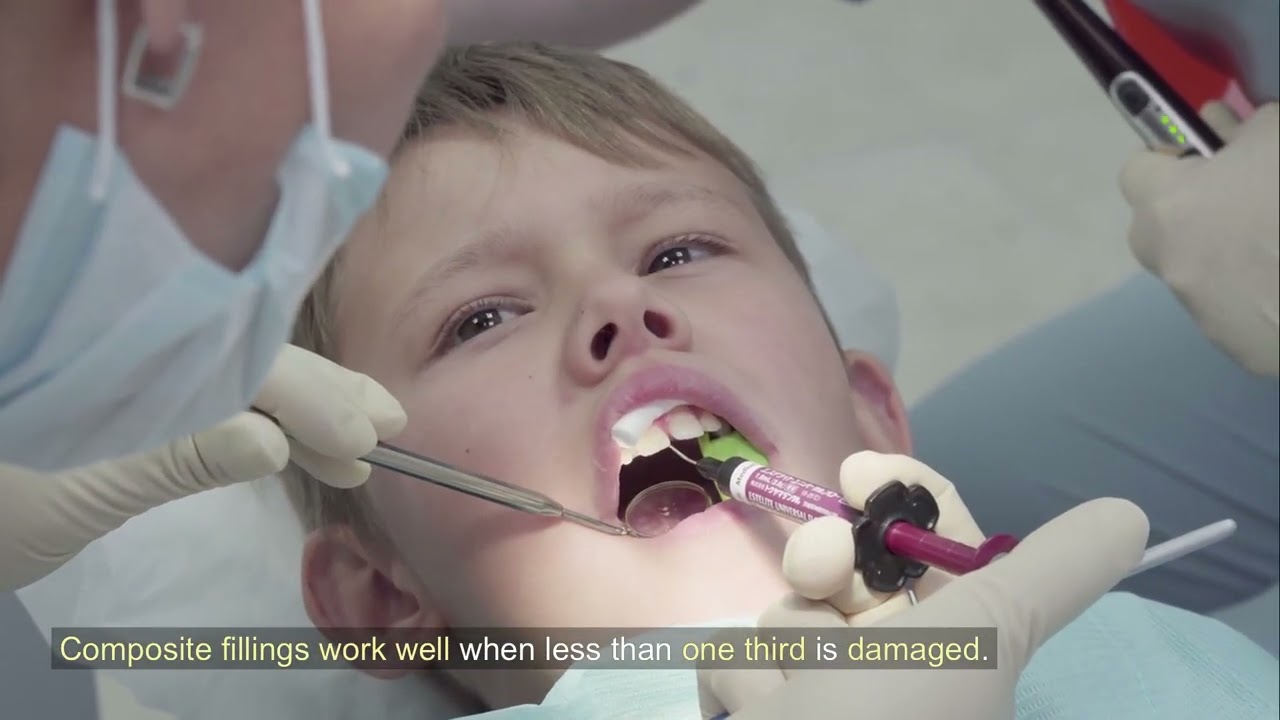 Porcelain Crowns vs. Composite Fillings - How Leesburg Dentists Decide Which One Your Tooth Actually