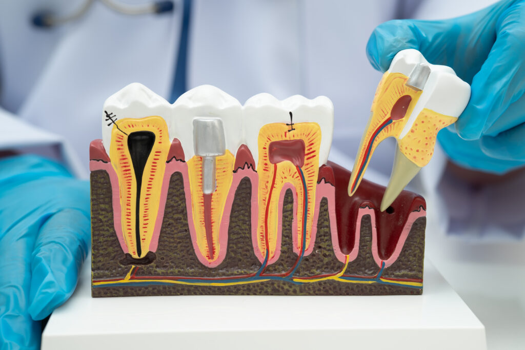 Root Canals Demystified
